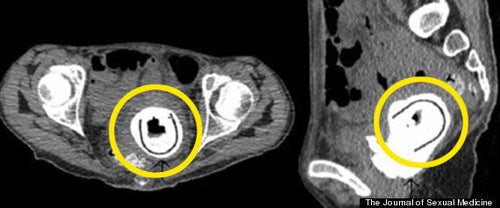 Sex Toy Remains Stuck In Woman's Vagina For 10 Years (PICTURE) | HuffPost  UK News