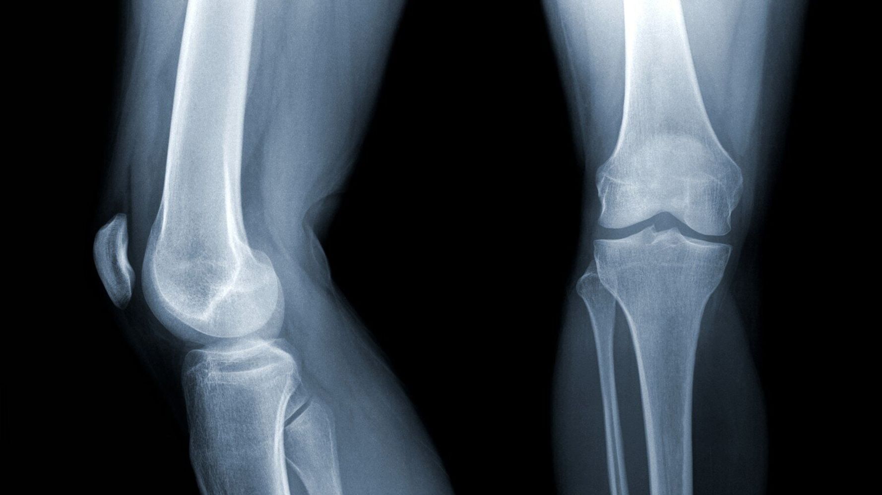 It's Time We Fixed the Problem of Poor Diagnosis for Osteoporosis ...