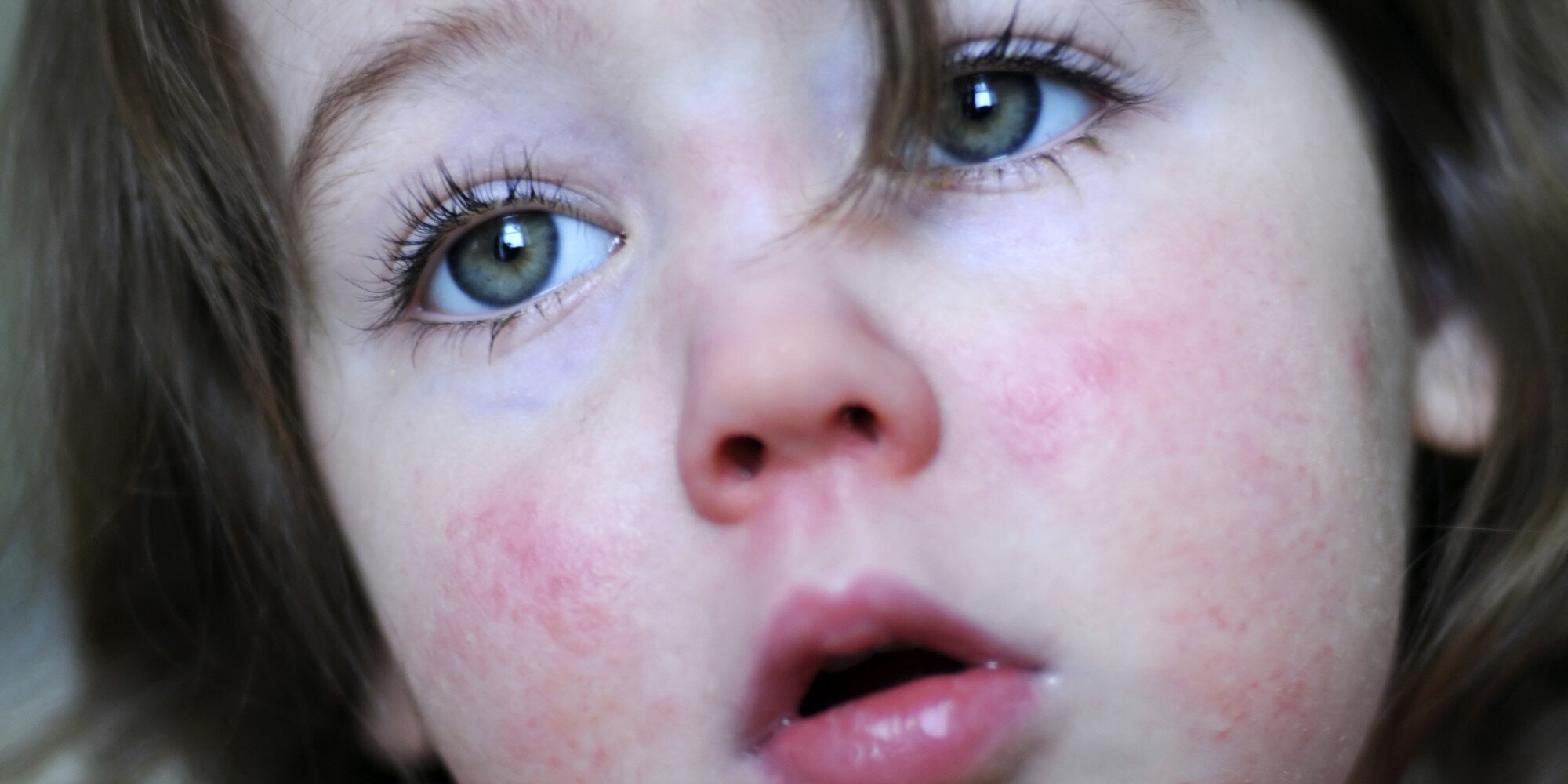 Scarlet Fever Cases At 24 Year High Here S How To Spot The Symptoms   5d02472a2100009518ef33a2 