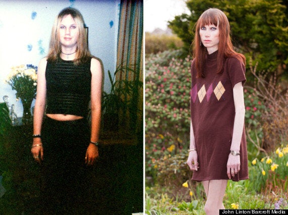 anorexia varicosei