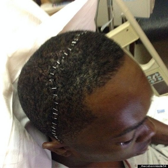 Aroldis Chapman struck in face by line drive, suffers fractures above left  eye and nose