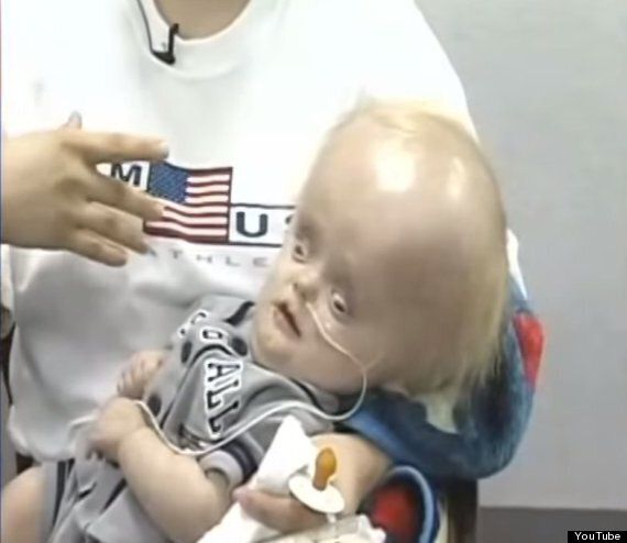 baby with no brain