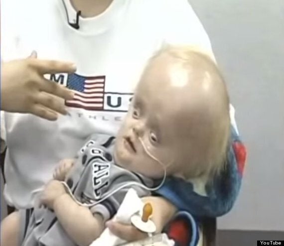 baby born without brain