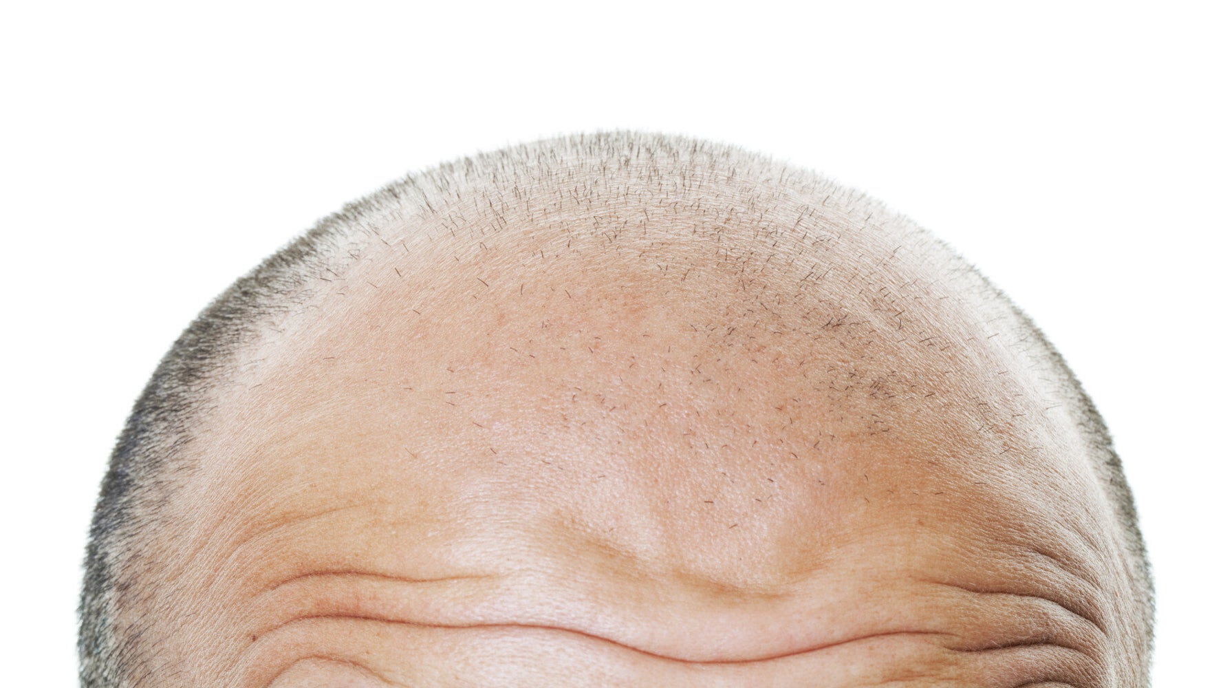 Growing" Popularity in Celebrity Hair Transplants | HuffPost UK Life
