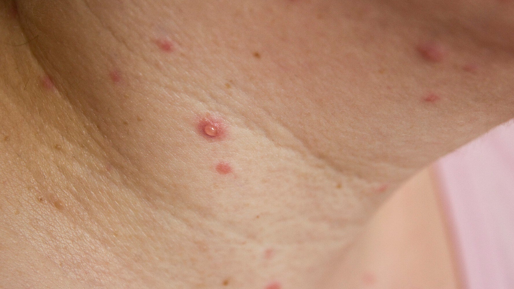 chicken pox pictures in adults