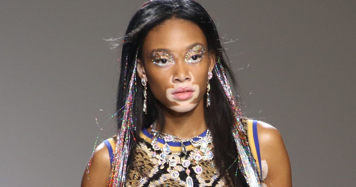 How Winnie Harlow Who Has Vitiligo Challenged All Perceptions About