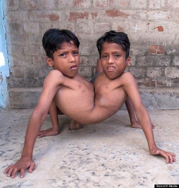 Conjoined Twins Shivanath and Shivram Sahu Perfect The 'Spider Walk ...