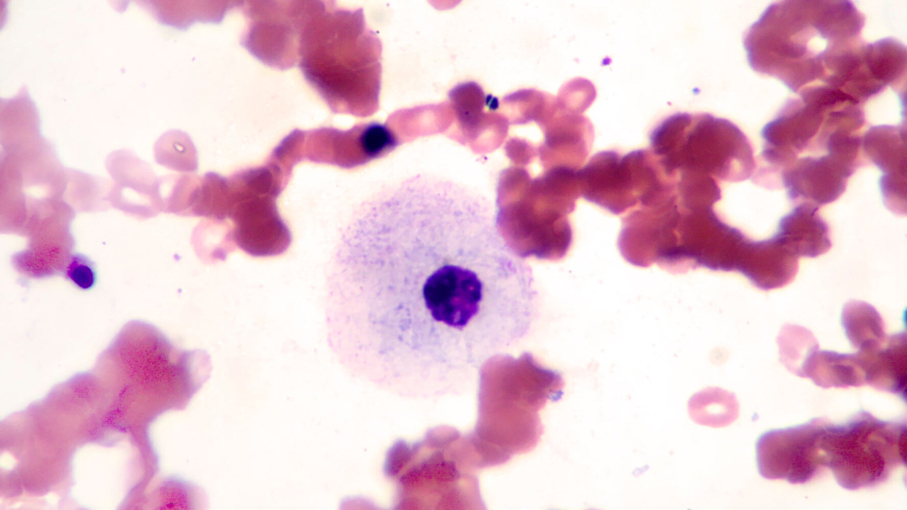 Gaucher A Rare Disease HuffPost UK Life