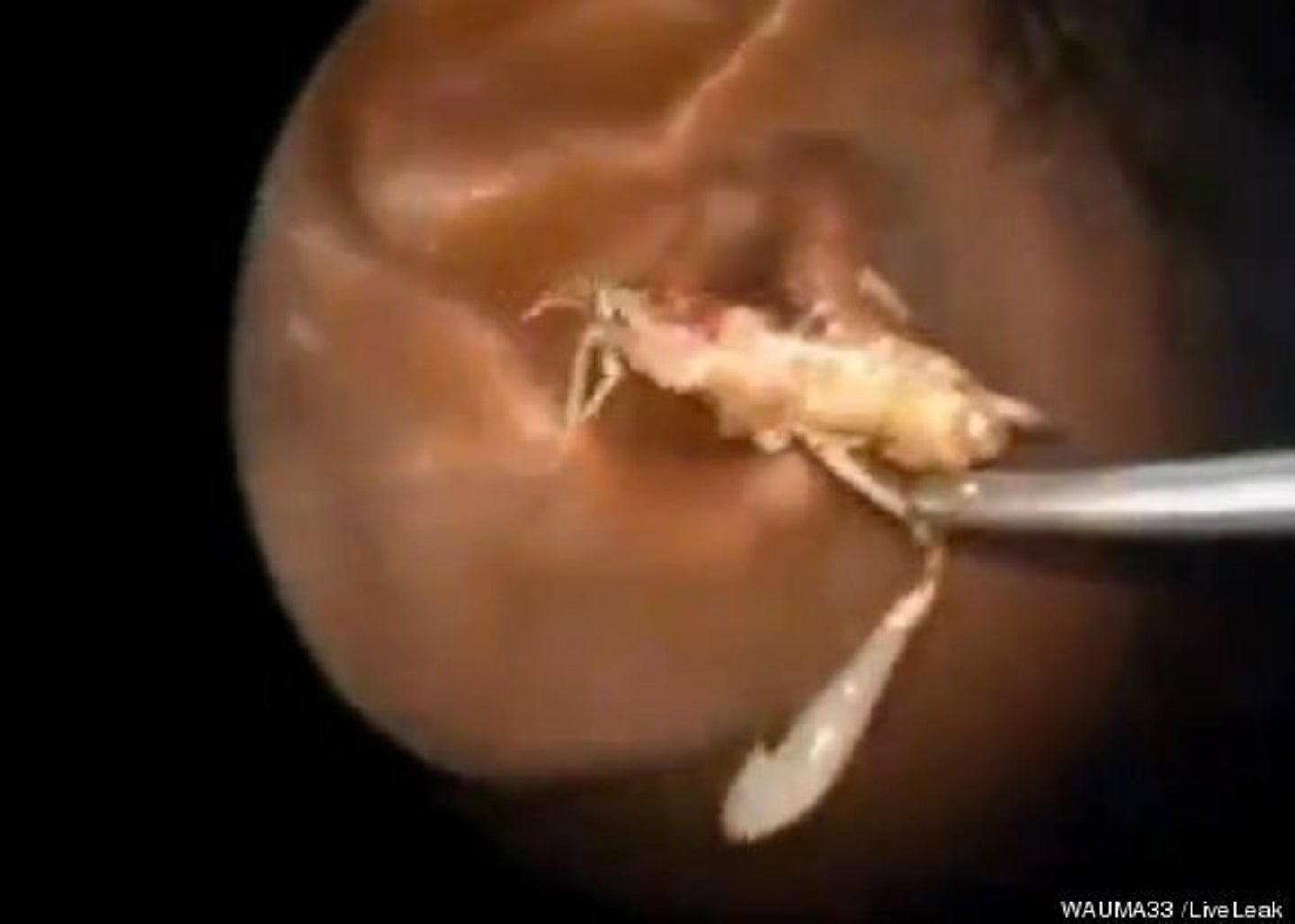 Live Three-Inch Cricket Found In Man's Ear By Doctors | HuffPost UK Life