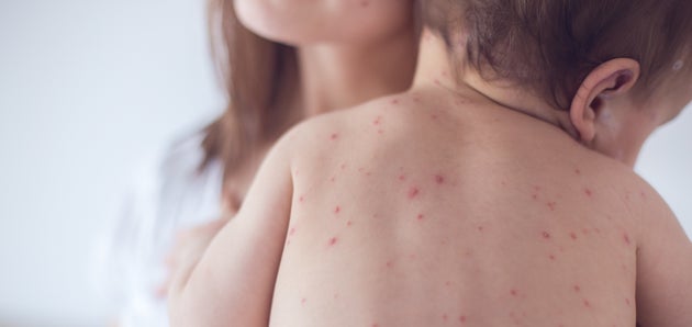 La varicelle est une maladie virale très