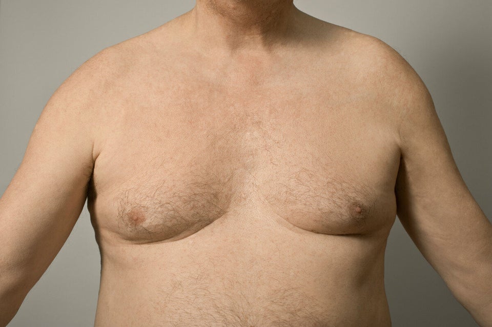 Gynaecomastia