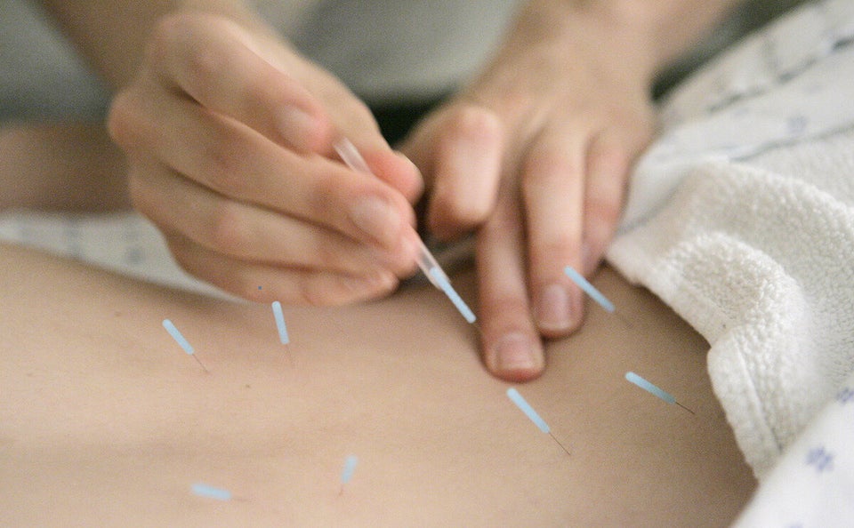 Acupuncture