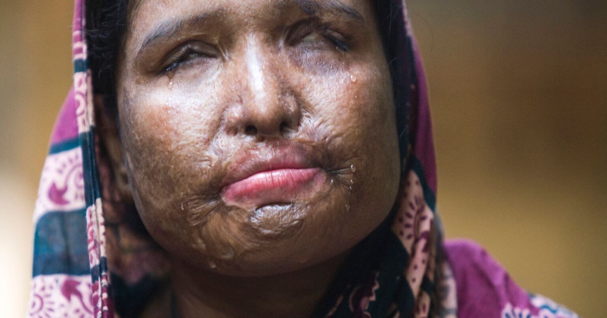 Acid Attack Victims Need Equality To Help Stop Violence, Says