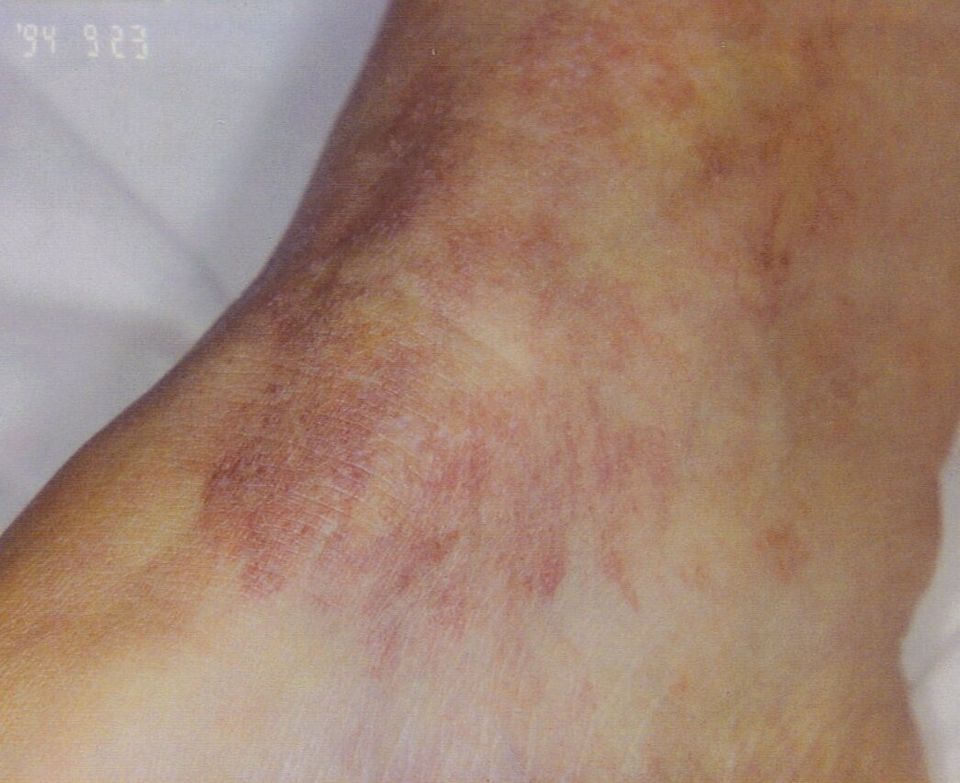 Leg flare before treatment