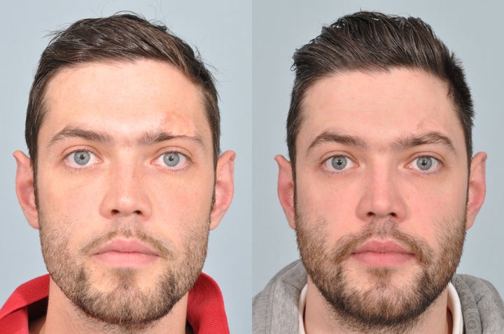 Transplant of neck hair to create a new eyebrow | HuffPost UK Life Transplant of neck hair to create a new eyebrow | HuffPost UK Life