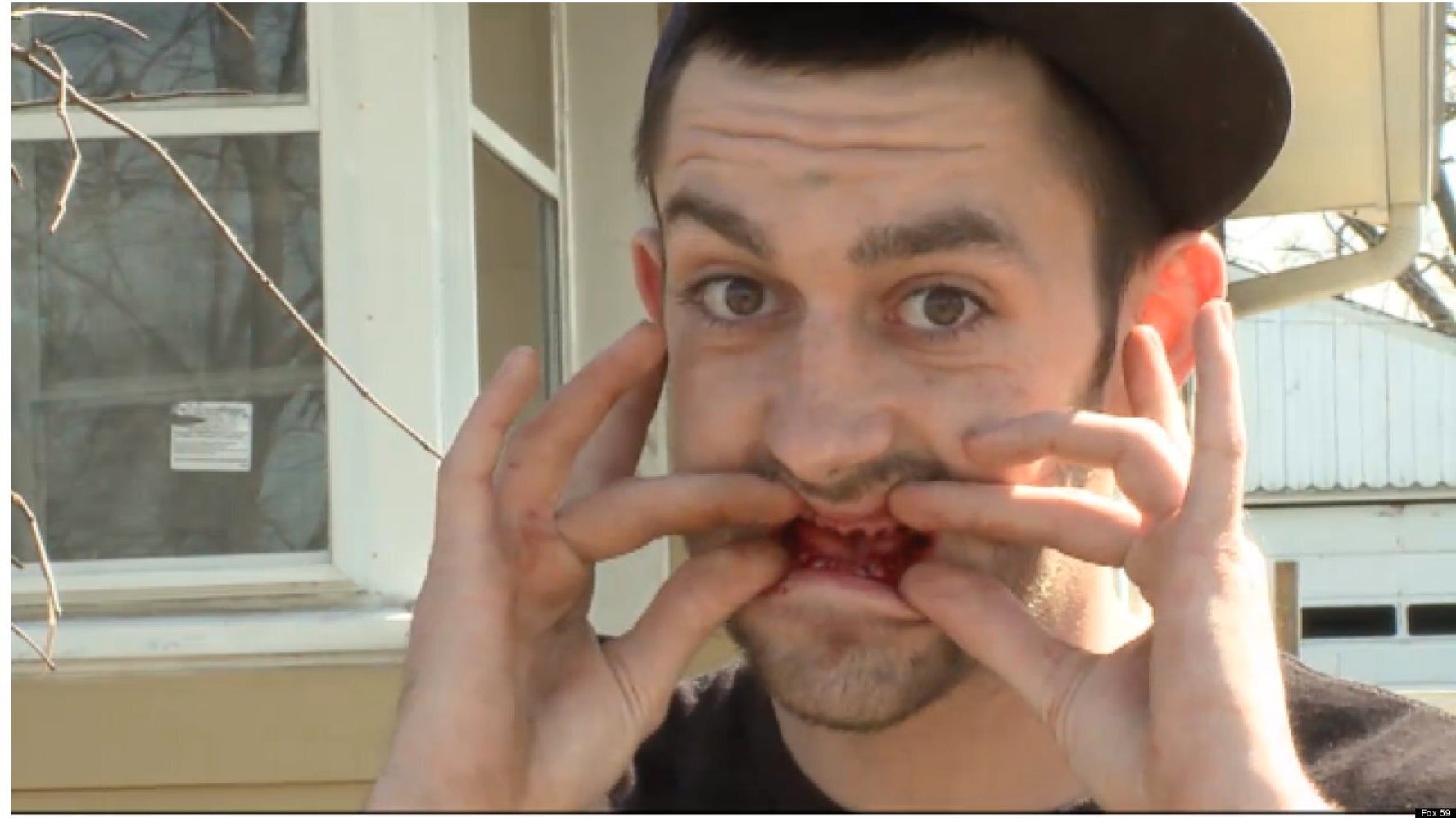Dentist Pulls All Of Man's Teeth Out Without Permission, Patient Says (GRAPHIC VIDEO, PHOTO) | HuffPost UK Life Dentist Pulls All Of Man's Teeth Out Without Permission, Patient Says (GRAPHIC VIDEO, PHOTO) | HuffPost UK Life