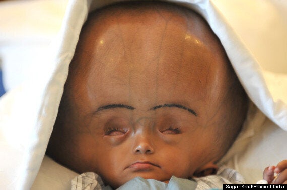 severe hydrocephalus