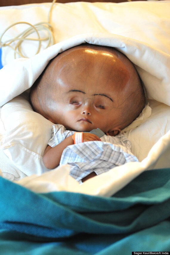 severe hydrocephalus