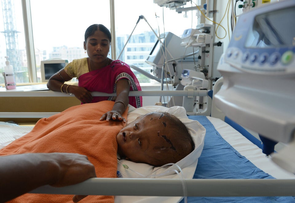 INDIA-HEALTH-ILLNESS-HYDROCEPHALUS