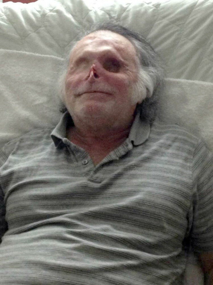 Ronald Poppo, Miami Cannibal Attack Victim ‘Living Happily' A Year