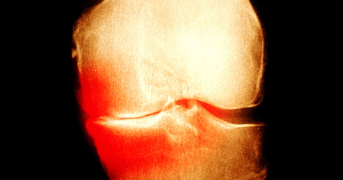 Why Do Some Sports Injuries Develop Into Osteoarthritis? HuffPost UK Life