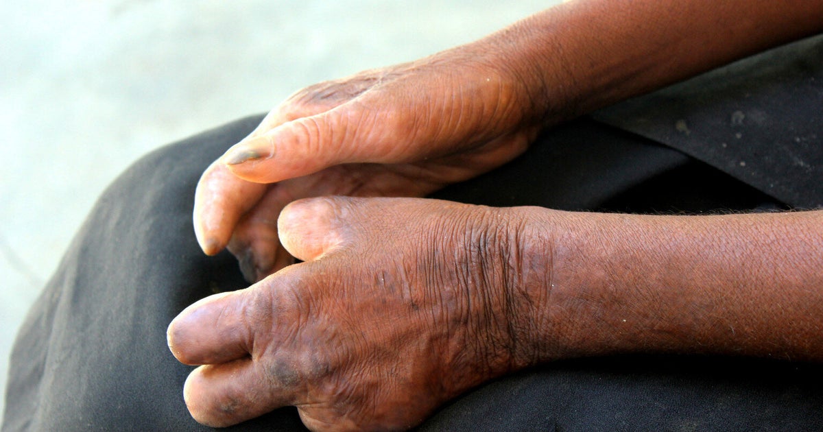 leprosy-why-treatment-needs-to-go-beyond-the-cure-huffpost-uk-news