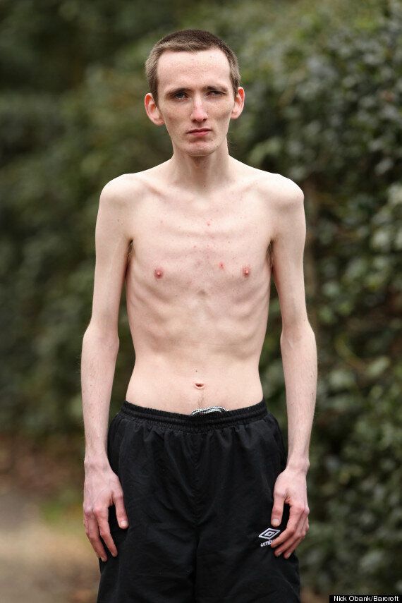 Marc Corn Anorexic Man Can Only Eat Chocolate Mousse And Custard After