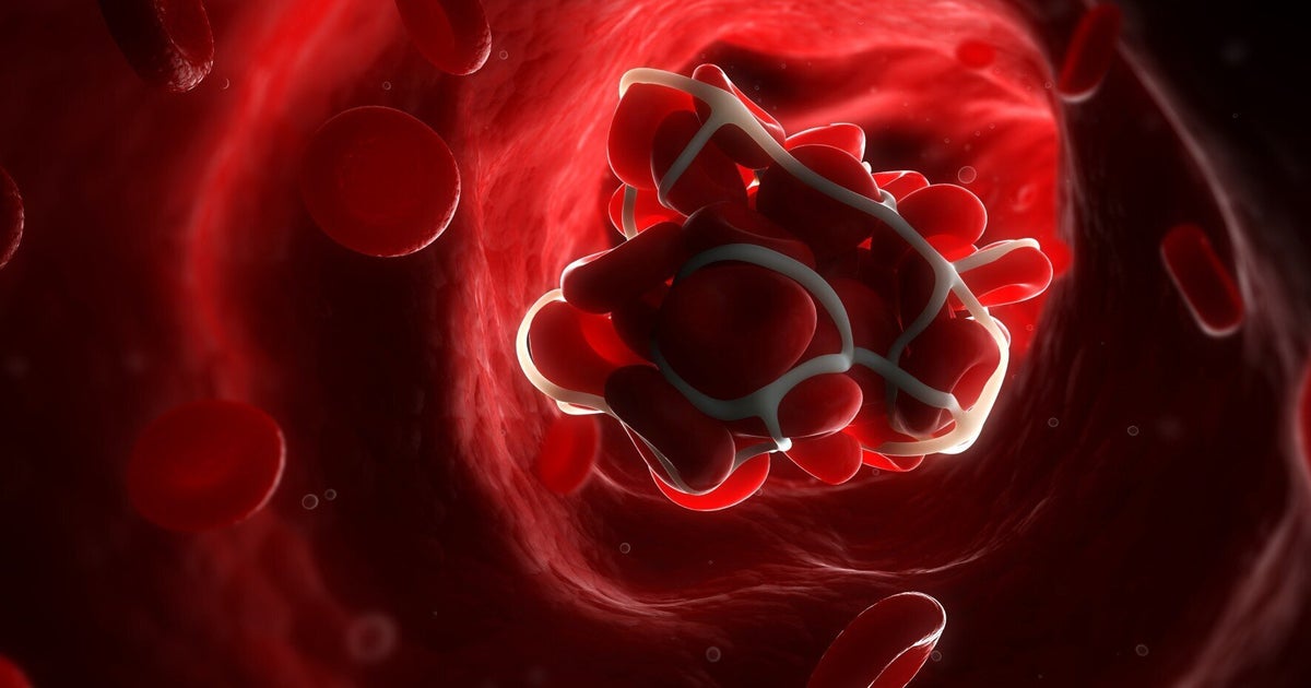 Blood Clots Are More Common (And Deadly) Than You May Think HuffPost