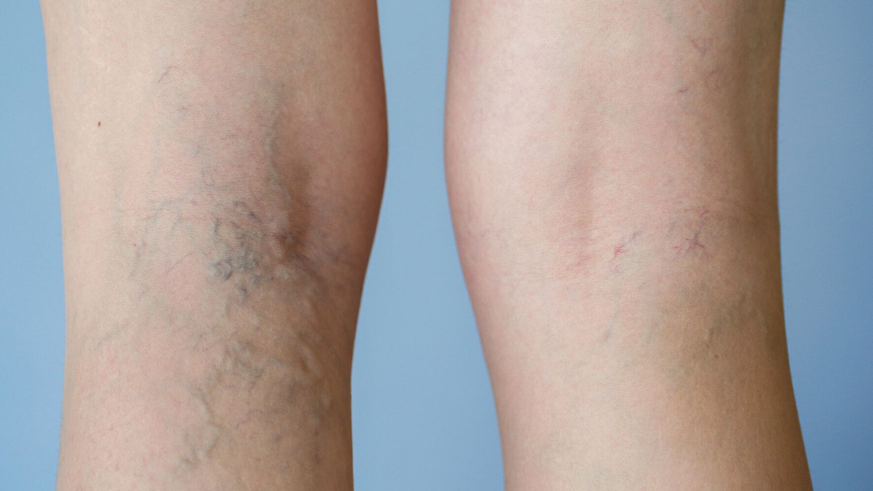 How Can I Get My Veins Done On The NHS?