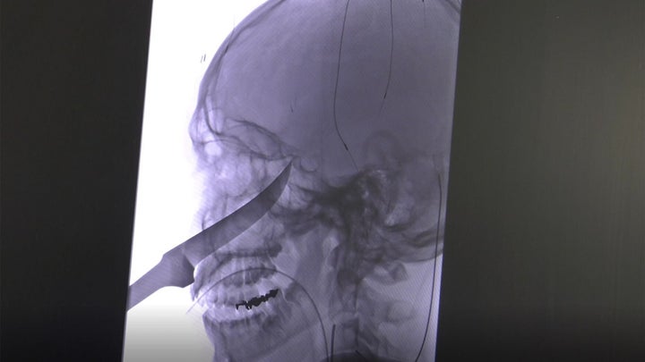 An X-ray shows the extent of the knife's penetration into the boy's head.