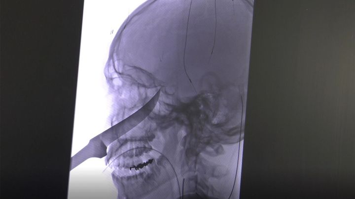 An X-ray shows the extent of the knife's penetration into the boy's head.