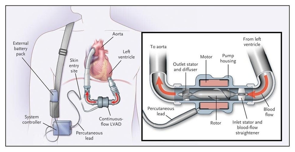 This diagram shows a left-ventricular assist device similar to those the Roman brothers use.