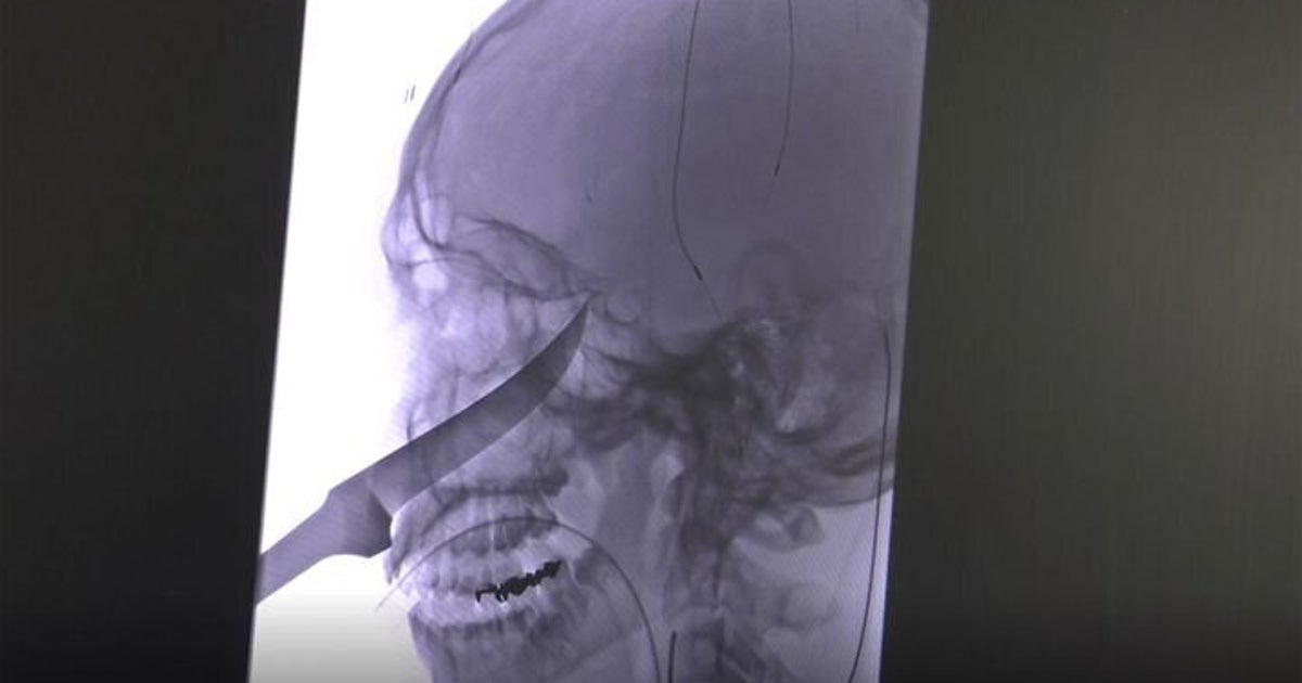 顔に25センチのナイフが刺さった少年 奇跡的に一命を取り止める ハフポスト 顔に25センチのナイフが刺さった少年 奇跡的に一命を取り止める ハフポスト