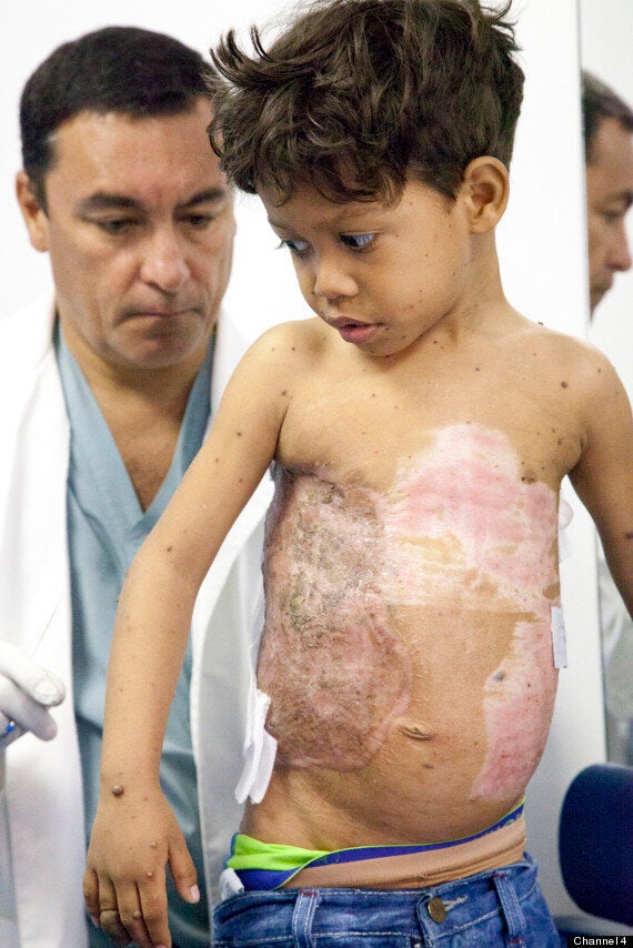 congenital melanocytic nevus turtle boy