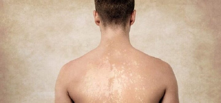 Des Taches Apres Le Soleil C Est Peut Etre A Cause Du Champignon De L Ete Le Huffington Post Life Des Taches Apres Le Soleil C Est Peut Etre A Cause Du Champignon De L Ete Le Huffington Post Life