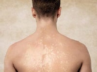 Des Taches Apres Le Soleil C Est Peut Etre A Cause Du Champignon De L Ete Le Huffington Post Life