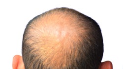 ¿Puedo quedarme calvo por llevar