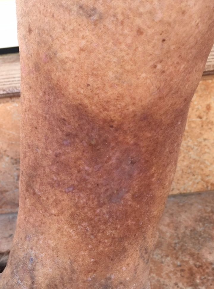 Jackie Lapper's damaged leg after suffering sepsis