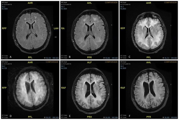 Progressive MRI scans. (A) MRI of the head on admission, (B) after5 days, (C) 2 weeks after admission, (D) 1 month after admission, (E) 3months after admission and (F) 10 months after admission.