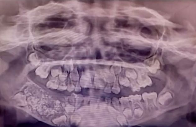 The excess teeth were found inside a tumour in his jawbone 