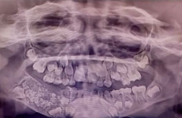 The excess teeth were found inside a tumour in his jawbone 