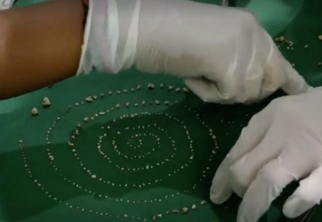 Surgeons lay out the teeth at a news conference announcing the successful surgery