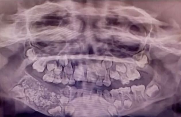 あご骨の中にある腫瘍に埋もれた歯