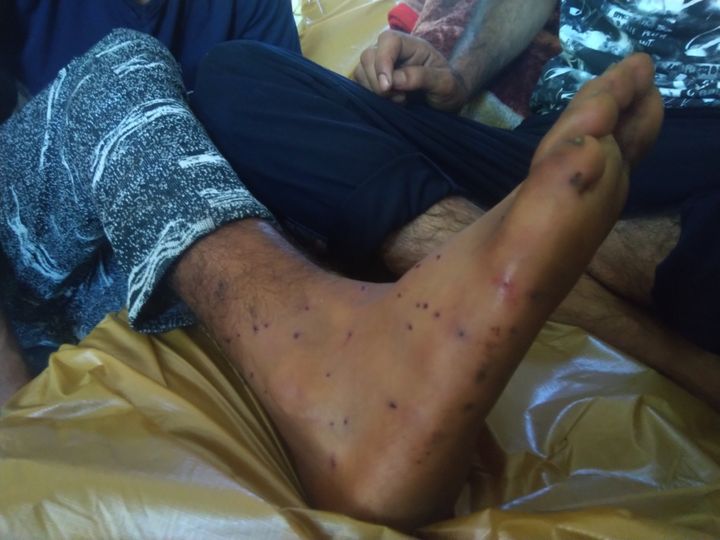 A young man with pellet injuries on his leg.