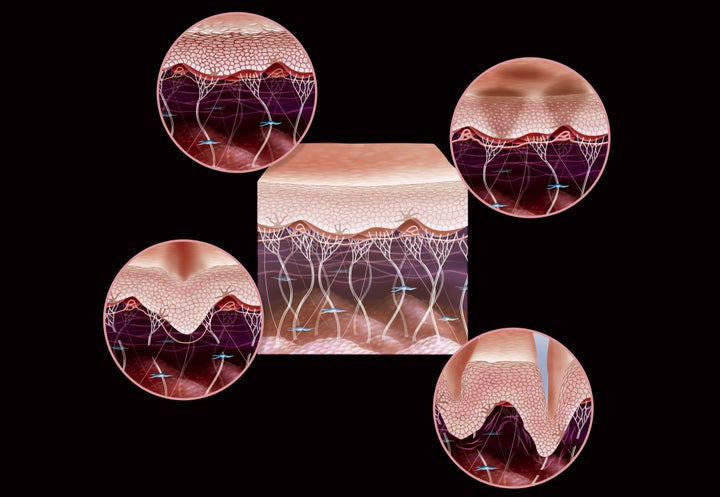 Illustration of the signs of aging in skin. Center: young skin. Top left: the dulling of the epidermis. Top right: spots. Bottom left: the loss of firmness due to diminished activity of the fibroblasts (in blue), which are responsible for skin's elasticity. Bottom right: wrinkles due to the deterioration of collagen (white vertical) and elastin (pink horizontal) fibers.