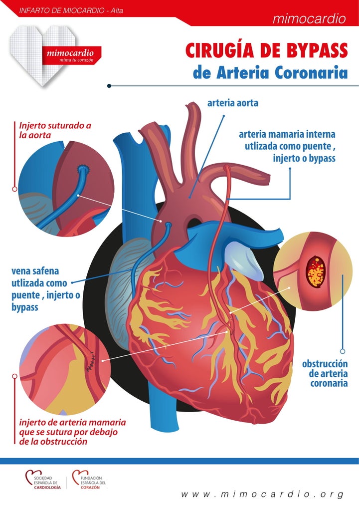 Fuente: <a href="https://mimocardio.org/images/2019/02/27/Cirugia-Bypass-Arteria-Coronaria.jpg" target="_blank" rel="noopener noreferrer">mimocardio.org</a>