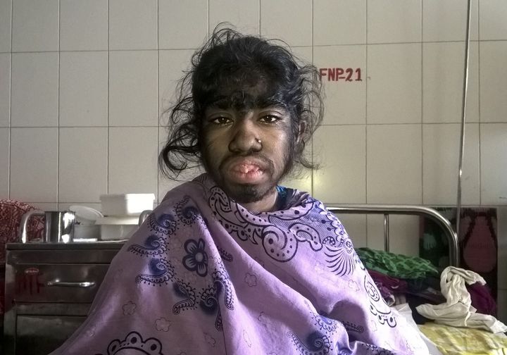 Bangladeshi patients Bithi Akhtar sits for a photograph as she waits in a ward at a hospital in Dhaka on May 12, 2016. The family of a 12-year-old Bangladeshi girl who suffers from a rare condition that causes thick hair to cover her face and body have spoken out as they seek to fund surgery to give their daughter a chance at a normal life. Bithi Akhtar suffers from Byars-Jurkiewicz syndrome and a complication known as hypertrichosis -- dubbed "werewolf syndrome". / AFP / STR (Photo credit should read STR/AFP/Getty Images)