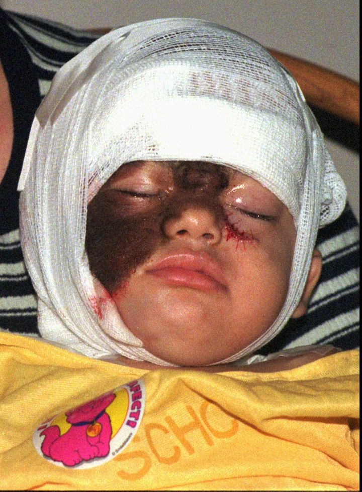 Abys DeJesus, 2, crys after facial surgery at St. Christopher's Hospital in Philadelphia August, 27, 1996. Abys suffers from "werewolf syndrome," and her family had traveled from Puerto Rico for treatment. (AP Photos/Sabina Pierce)