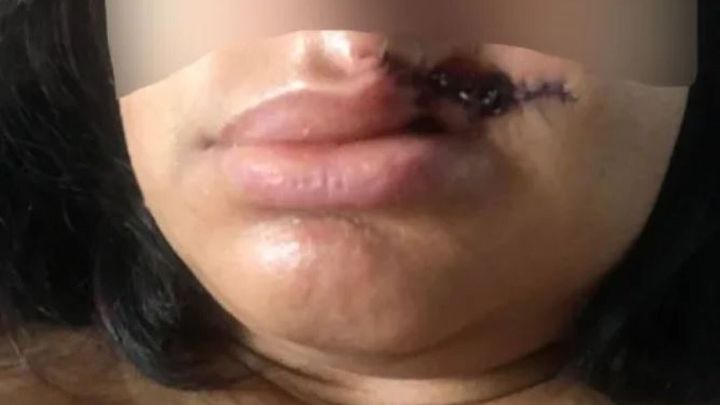 Άνδρας επιτέθηκε σε άγνωστη γυναίκα και της ξέσκισε το άνω χείλος.