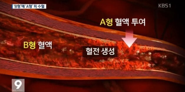 종합병원이 수술 중 'B형 환자'에게 'A형 피'를 수혈했다 | 허프포스트코리아